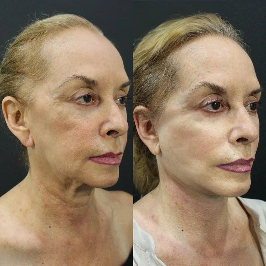 A patient before and after a deep plane face and neck lift by Dr. Quiroz