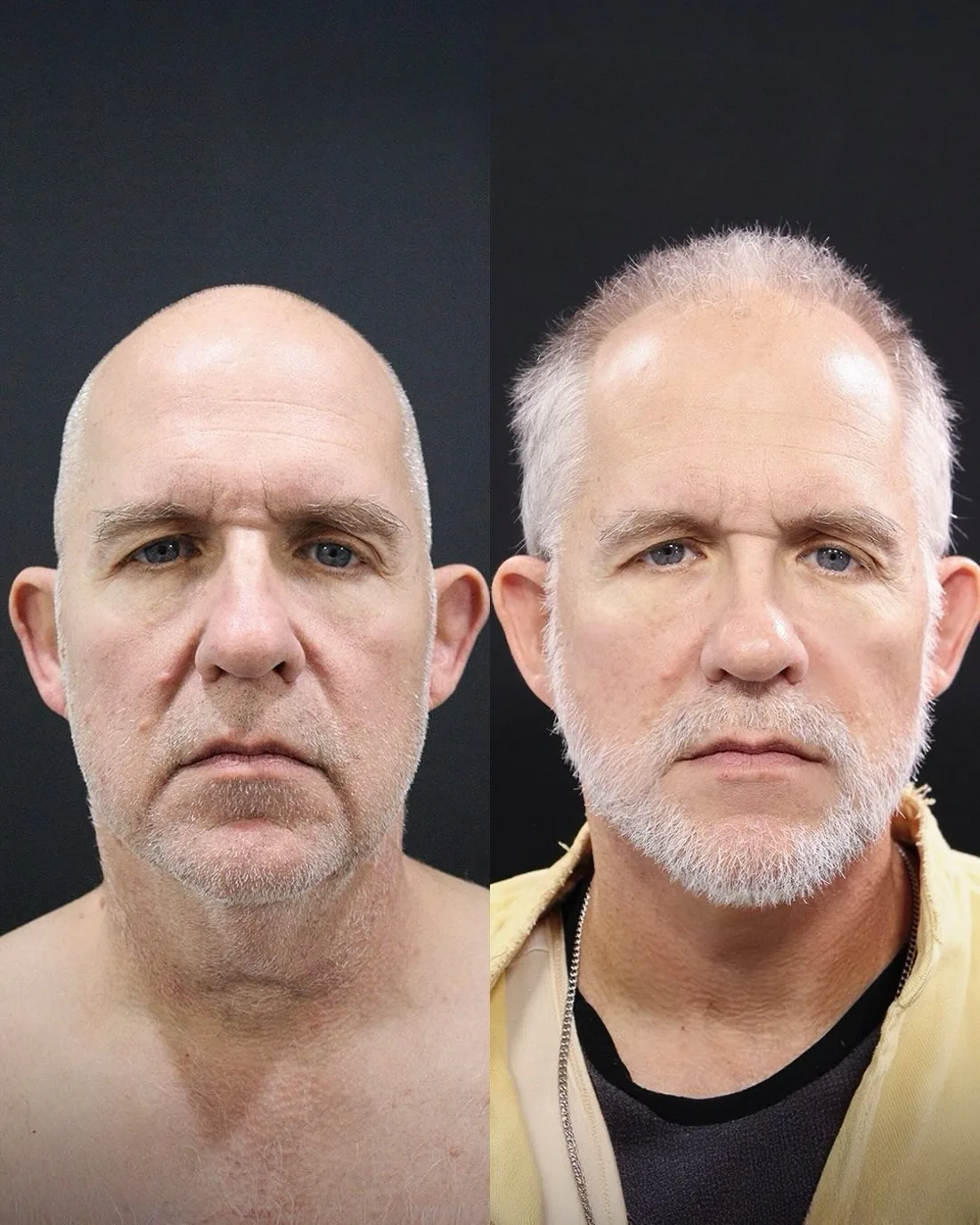 A patient before and after a deep plane facelift by Dr. Quiroz