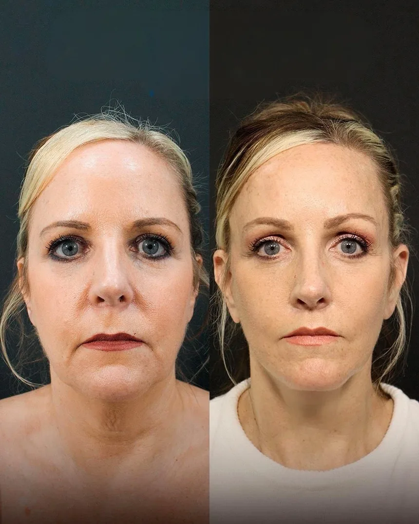 A patient before and after a face, neck and brow lift + lip enhancement and fat transfer to lips, using the deep plane technique. Individual results vary.