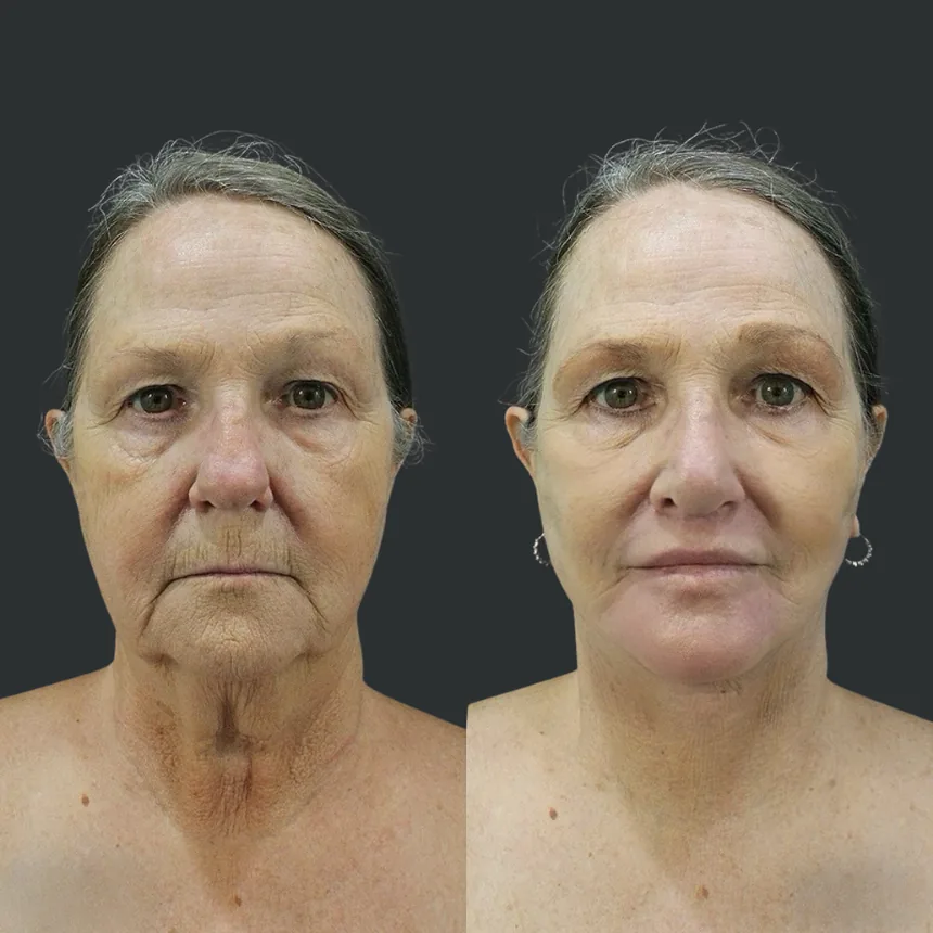 A patient before and after a face, neck, rhinoplasty, fat transfer to lips + lip lift and dermabrasion, using the deep plane technique. Individual results vary.