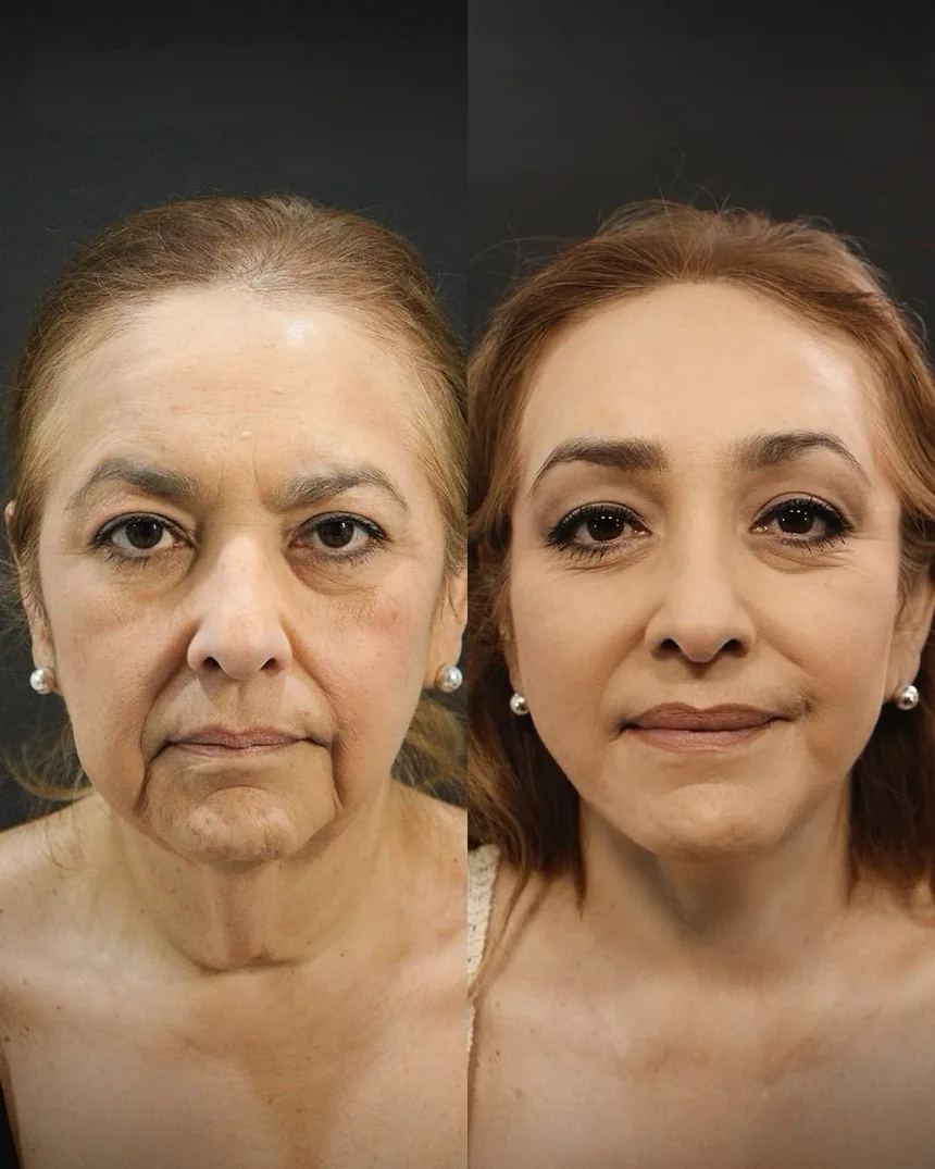 A patient before and after a face and neck + upper eyelid surgery, using the deep plane technique. Individual results vary.