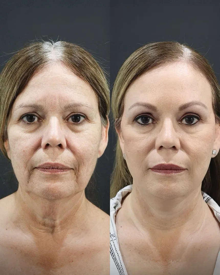A patient before and after a face and neck lift and upper lip dermabrasion, using the deep plane technique. Individual results vary.