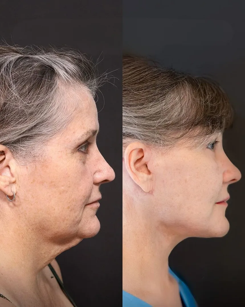 A patient before and after a face and neck lift + lower eyelid surgery, using the deep plane technique. Individual results vary.