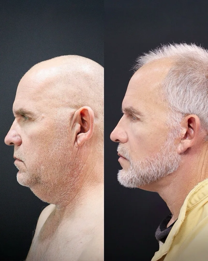 A patient before and after a lower face and neck lift by Dr. Quiroz. Individual results vary.