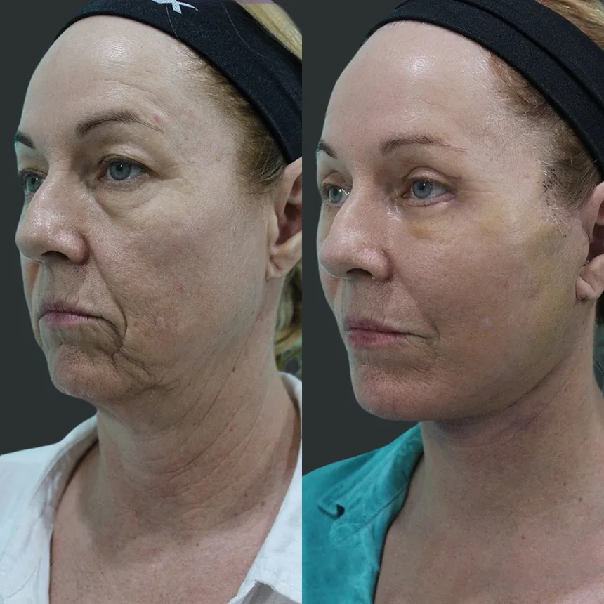 A patient before and after a face and neck lift, using the deep plane technique. Individual results vary.