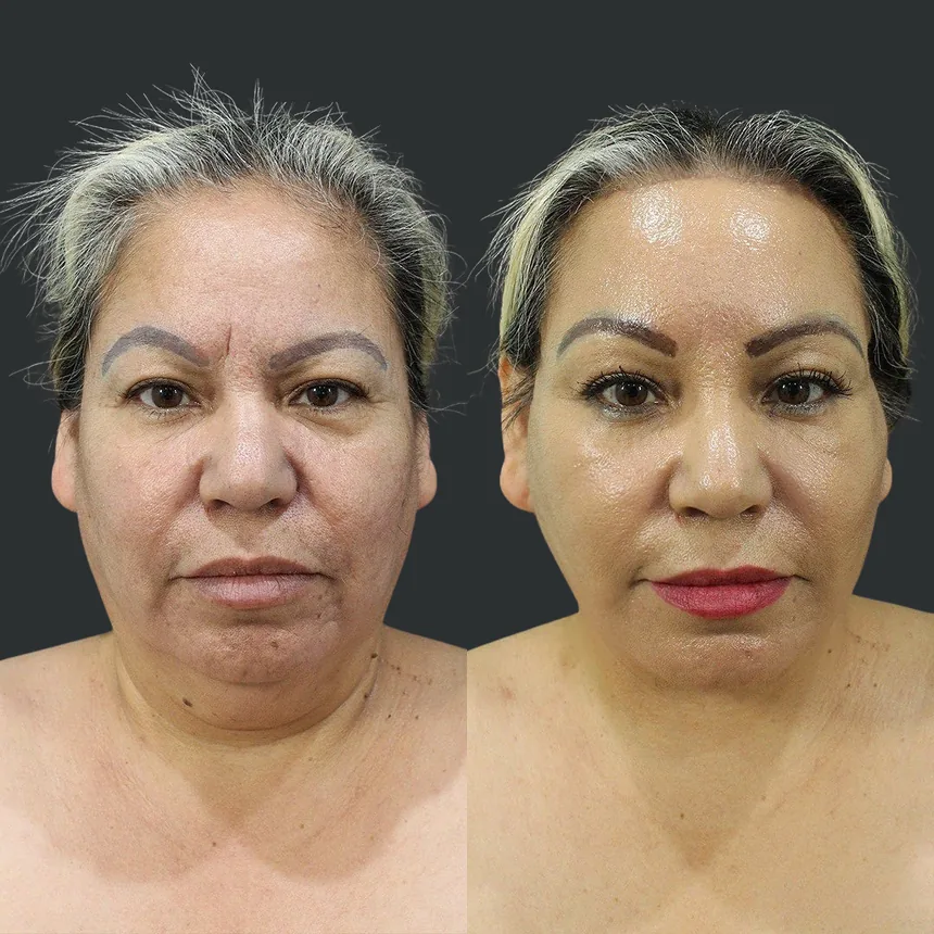 A patient before and after a face and neck lift + brow lift, using the deep plane technique. Individual results vary.