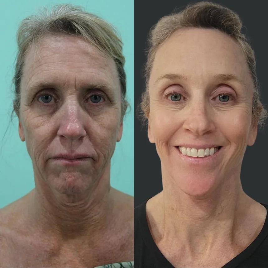A patient before and after a face and neck lift + brow lift, using the deep plane technique. Individual results vary.