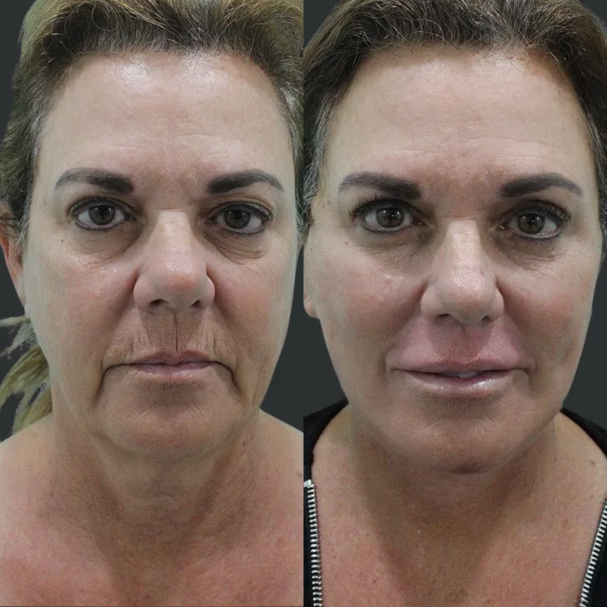 A patient before and after a face and neck lift, fat transfer to lips + dermabrasion, using the deep plane technique. Individual results vary.