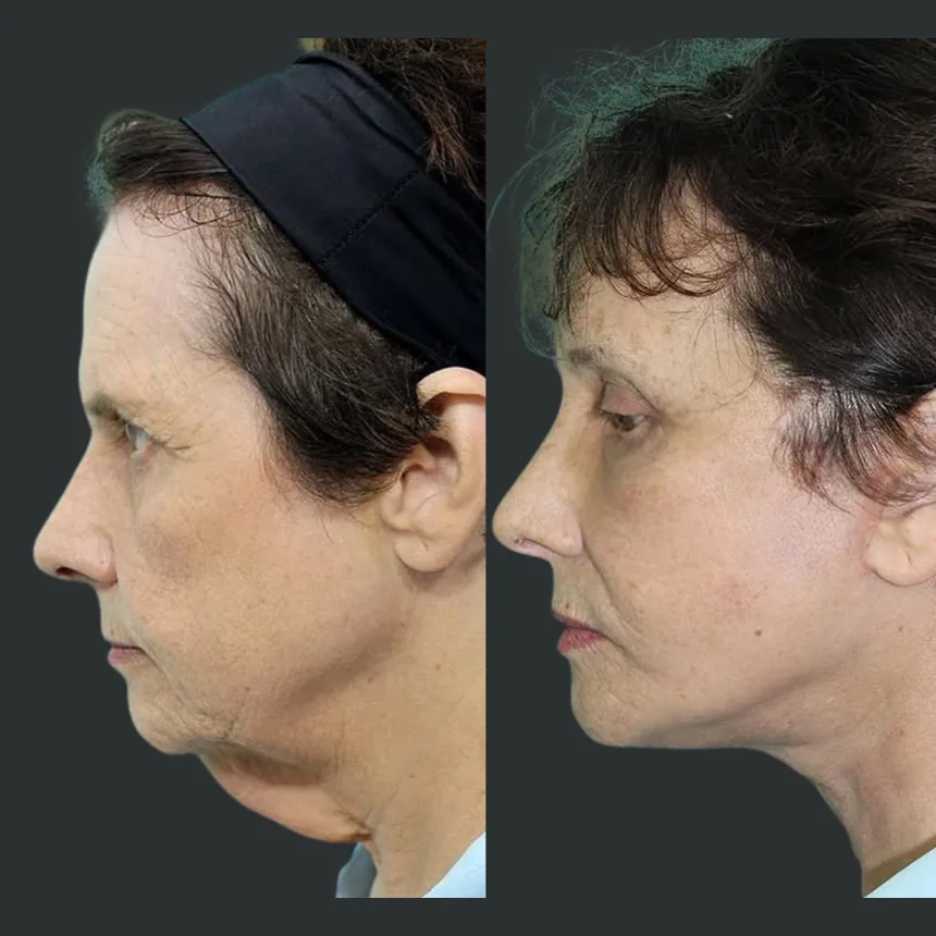 A patient before and after a face and neck lift, using the deep plane technique. Individual results vary.