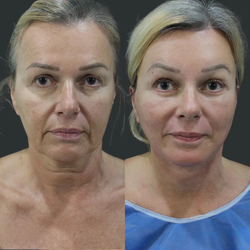 A patient before and after a face, neck and brow lift + lower eyelid surgery + dermabrasion, using the deep plane technique. Individual results vary.