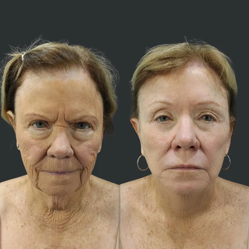 A patient before and after a face, neck and brow lift, lower eyelid + fat transfer to lips and dermabrasion, using the deep plane technique. Individual results vary.