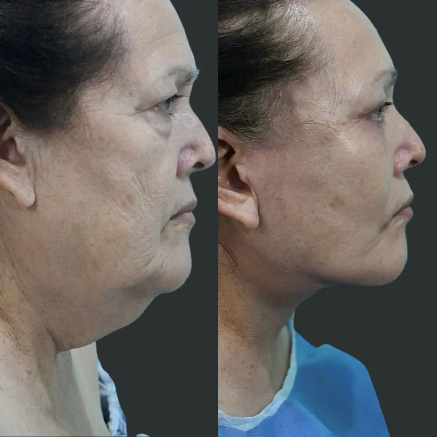 A patient before and after a face, neck lift and lower eyelid surgery, using the deep plane technique. Individual results vary.