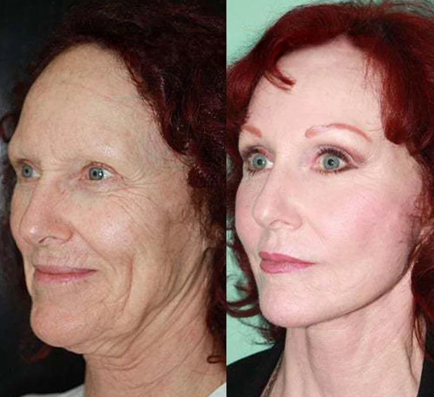 A patient before and after a face and neck lift, using the deep plane technique. Individual results vary.