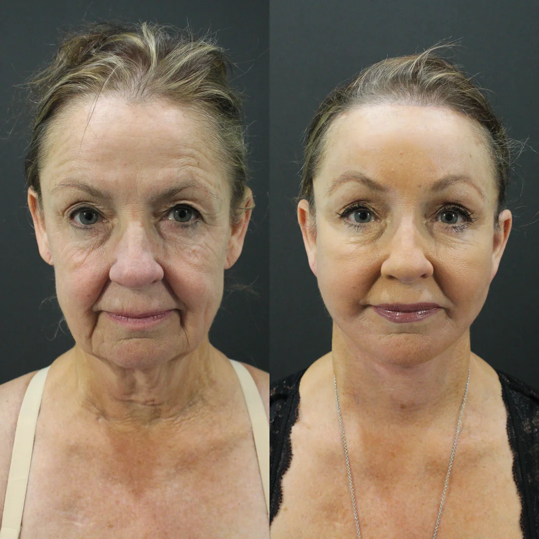 A patient before and after a face, neck and brow lift, using the deep plane technique. Individual results vary.