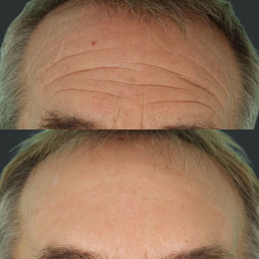 A patient before and after a brow lift, using the deep plane technique. Individual results vary.
