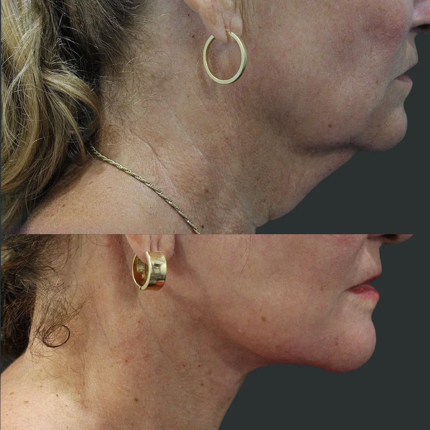 A patient before and after a neck lift, using the deep plane technique. Individual results vary.