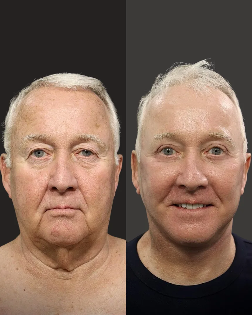 A patient before and after a face and neck lift, eyelid surgery and co2 laser, using the deep plane technique. Individual results vary.