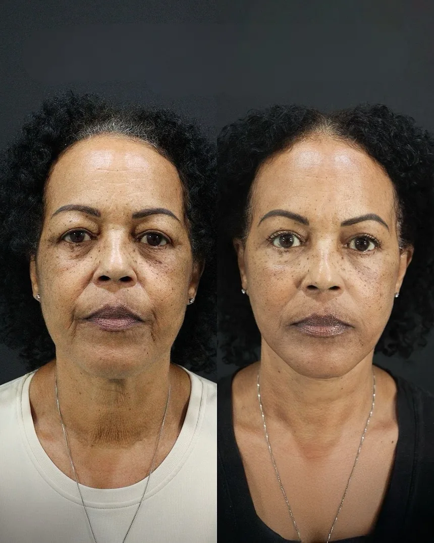 A patient before and after a face and neck lift + upper eyelid surgery, using the deep plane technique. Individual results vary.