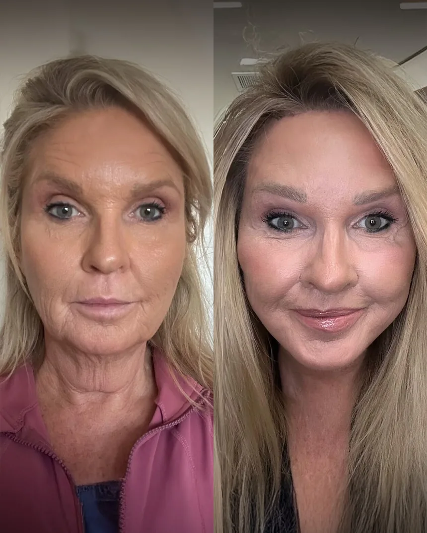 A patient before and after a face, neck and brow lift + co2 laser, using the deep plane technique. Individual results vary.