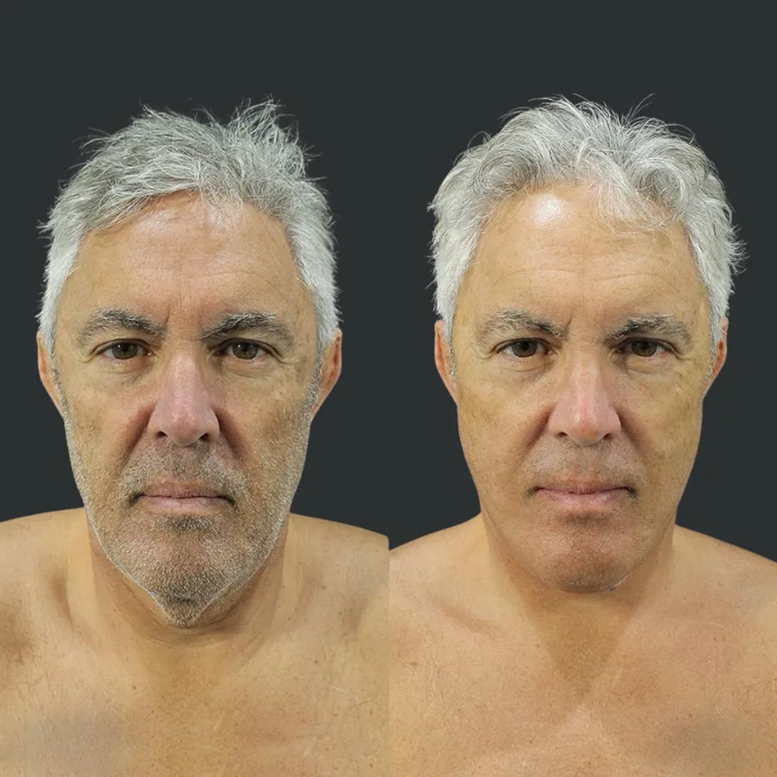 A patient before and after a face and neck lift, using the deep plane technique. Individual results vary.