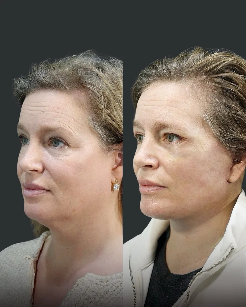 A patient before and after a face and neck lift + lower eyelid surgery, using the deep plane technique. Individual results vary.
