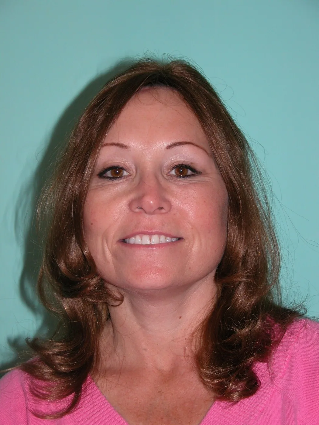 The same patient after her deep plane face and neck lift. Individual results vary.