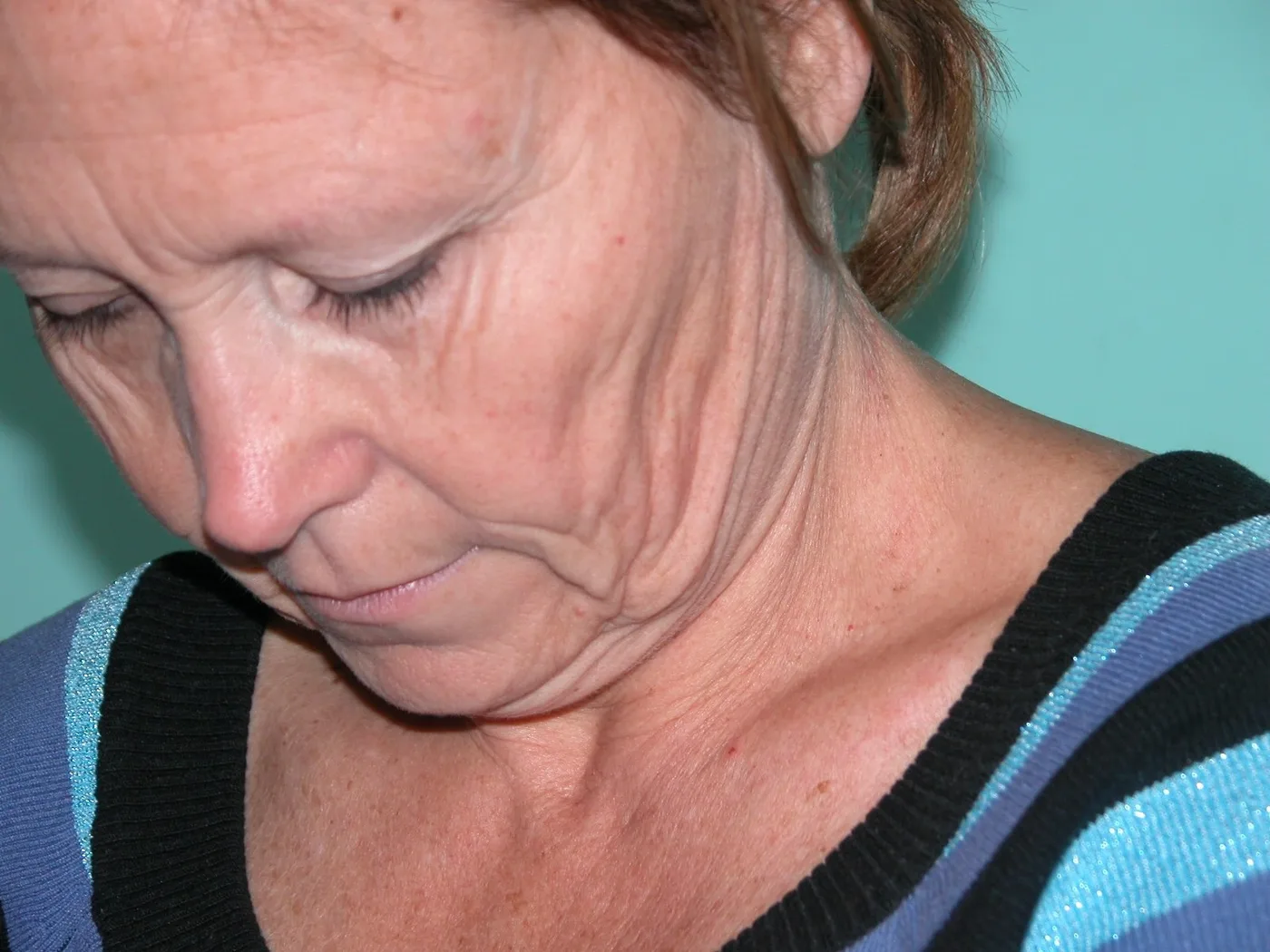 Close view of the same face before surgery: folds of loose skin along the jaw and neck.