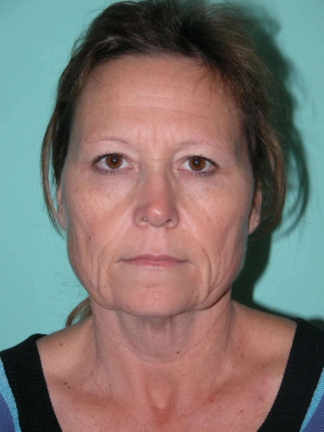 The patient after major weight loss and before surgery, with deflation of the midface and loose skin along the jaw and neck.