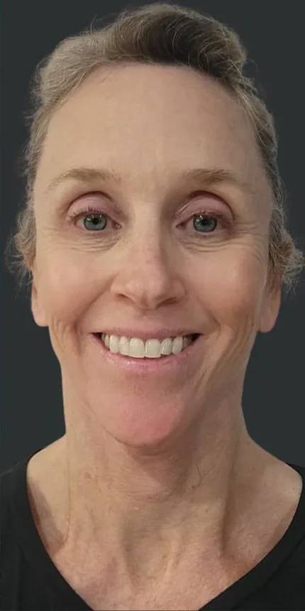 Nine months after a face and neck lift with brow lift by Dr. Quiroz: the brow rested, not raised. Individual results vary.