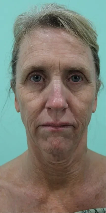 Before a face, neck and brow lift: the brow resting low, the eyes reading heavy.