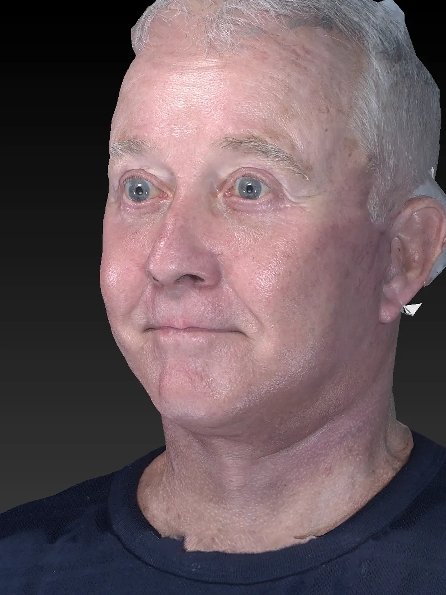 After a deep plane facelift, a three-dimensional view of the same face with a restored jawline and neck. Individual results vary.