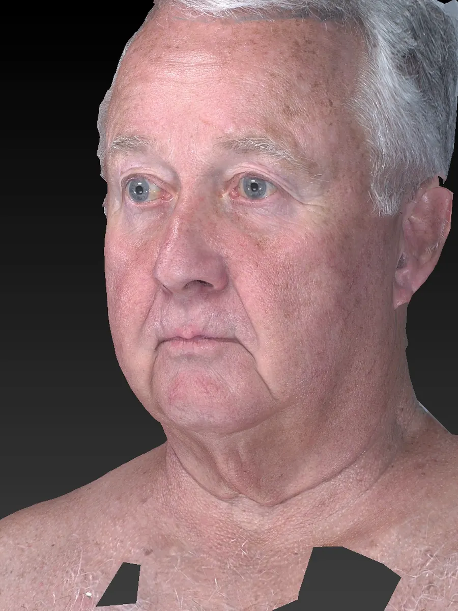 Before a deep plane facelift, a three-dimensional view of an aged lower face and neck.