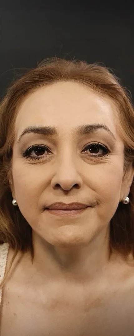 Nine months after a face and neck lift with upper eyelid surgery by Dr. Quiroz: the eyes open and rested. Individual results vary.