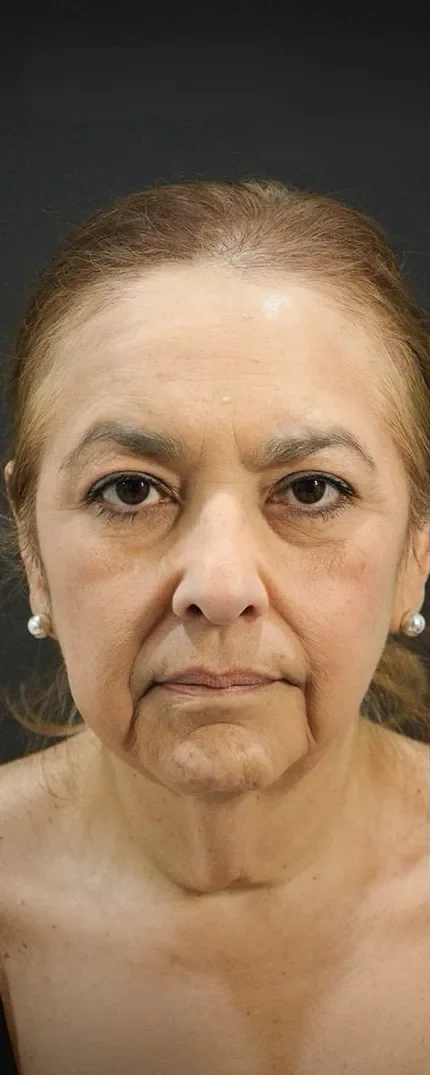 Before a face and neck lift with upper eyelid surgery: heavy upper lids crowding the eyes.