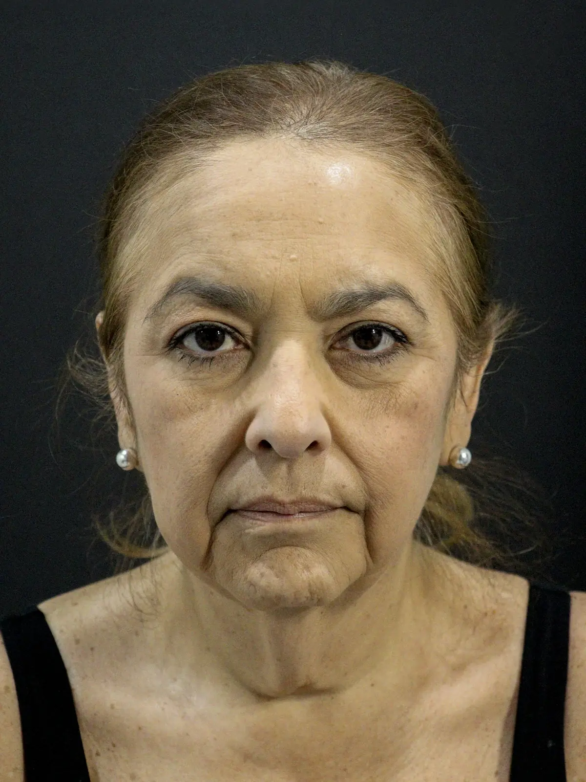 A patient before a deep plane face and neck lift