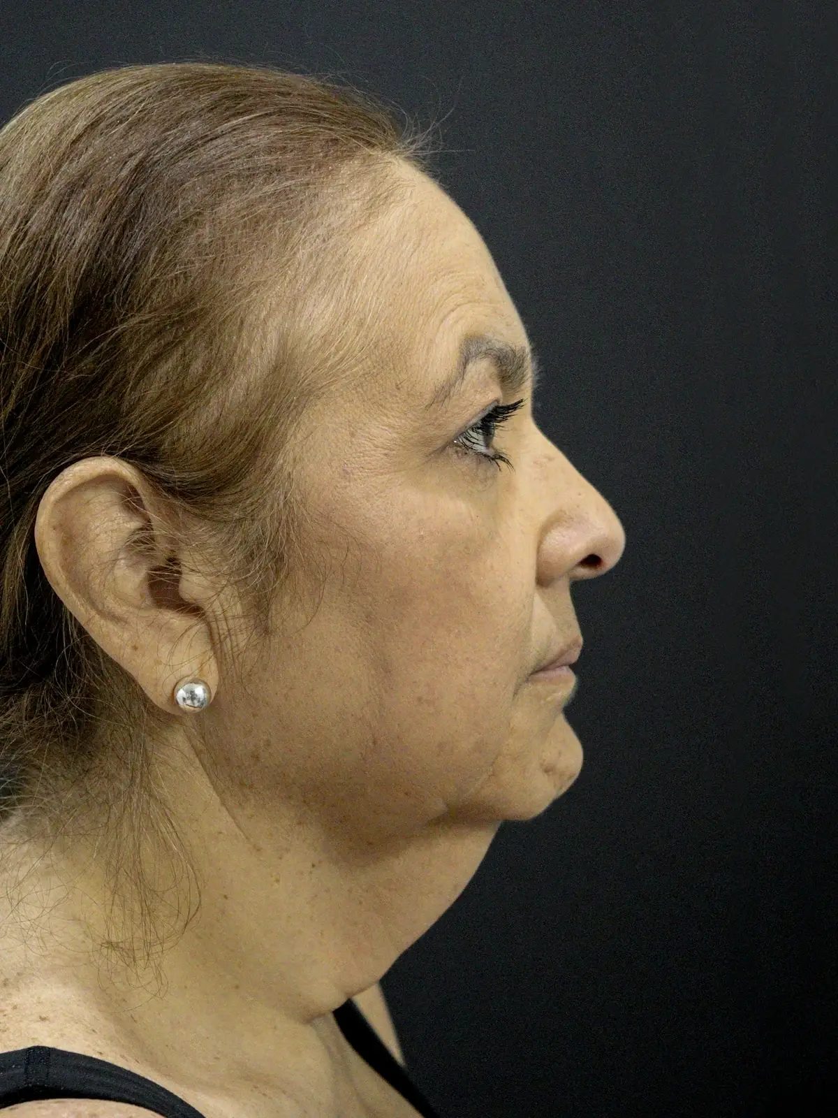 A patient's jawline in profile before a deep plane facelift with Dr. Quiroz