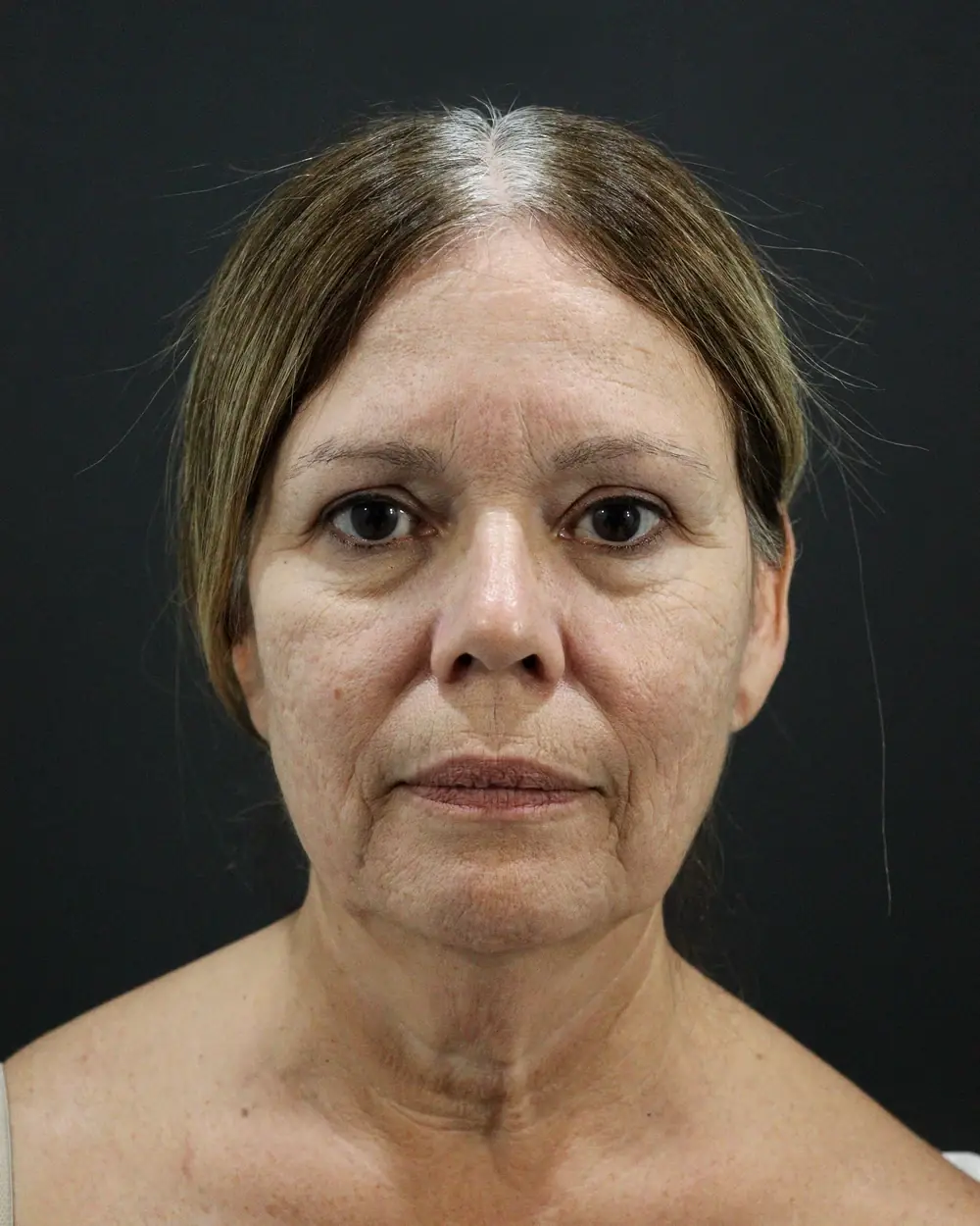 A patient before a deep plane facelift with Dr. Quiroz