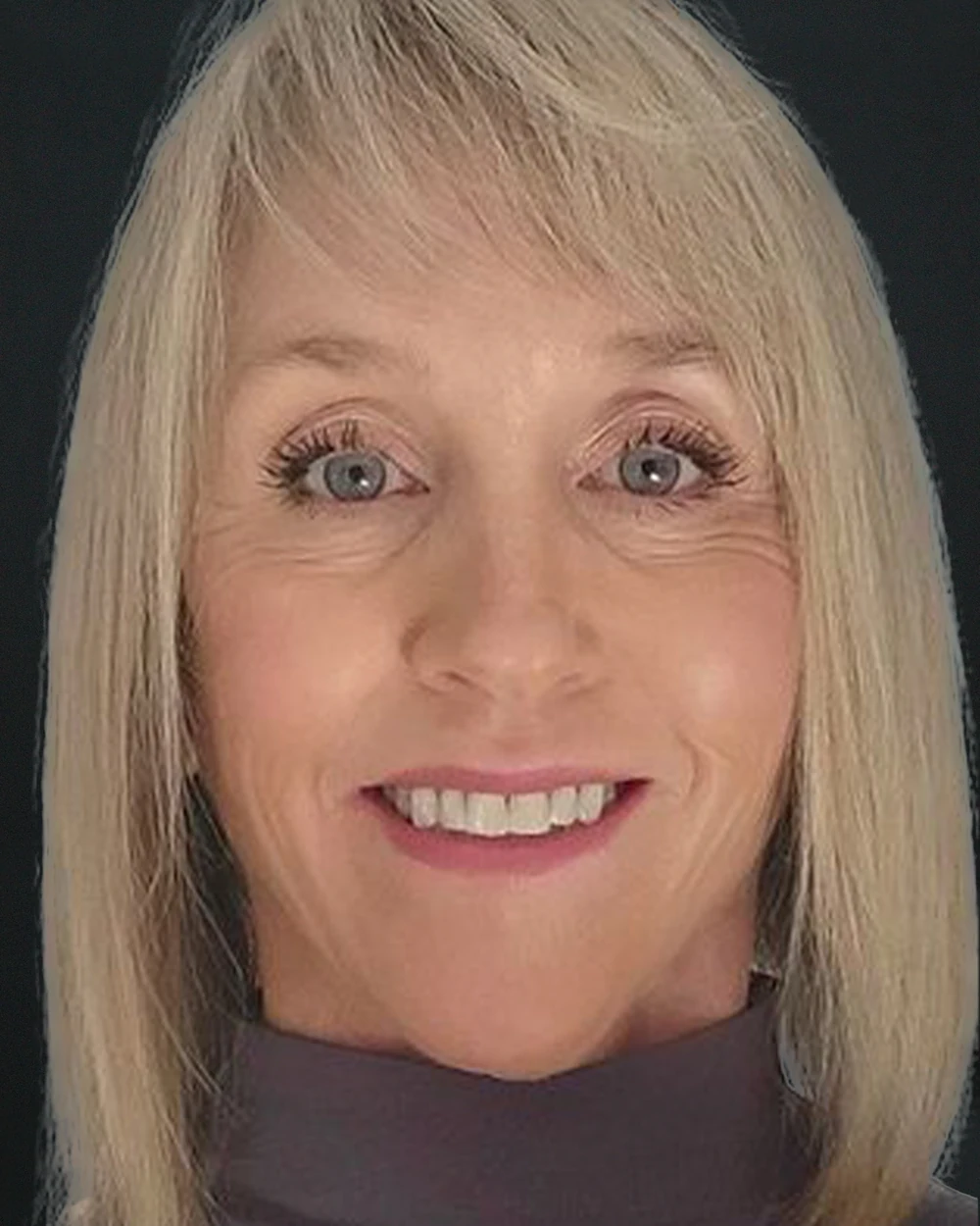 The same patient after a deep plane facelift: the structural change no non-surgical bundle produces. Individual results vary