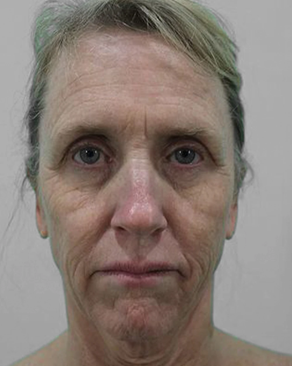 A patient before a deep plane facelift with Dr. Quiroz