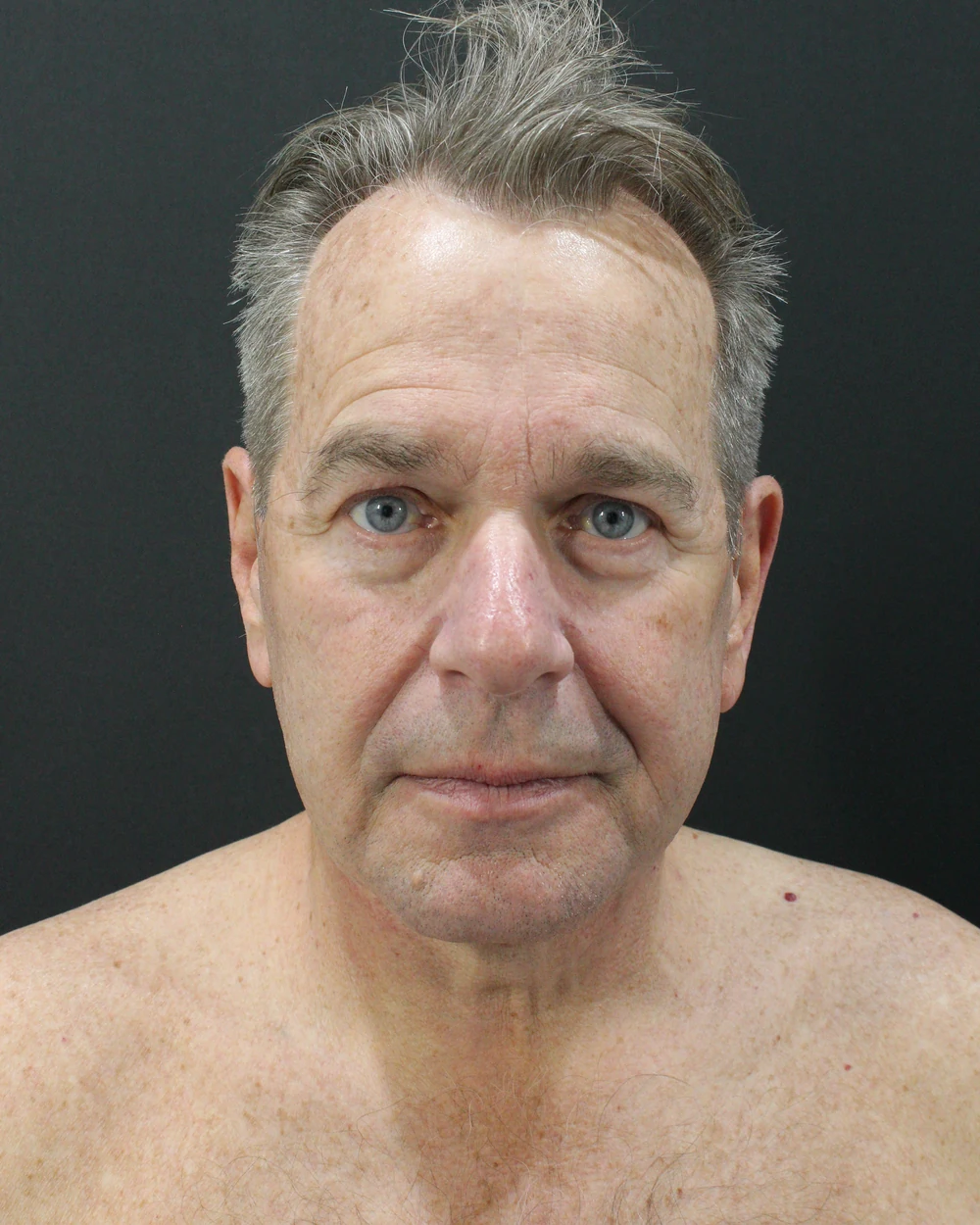 The same patient after a deep plane facelift: descent lifted, not inflated. Individual results vary