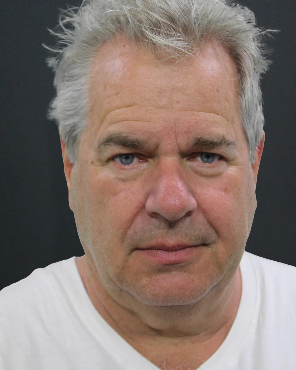A patient before a deep plane facelift with Dr. Quiroz
