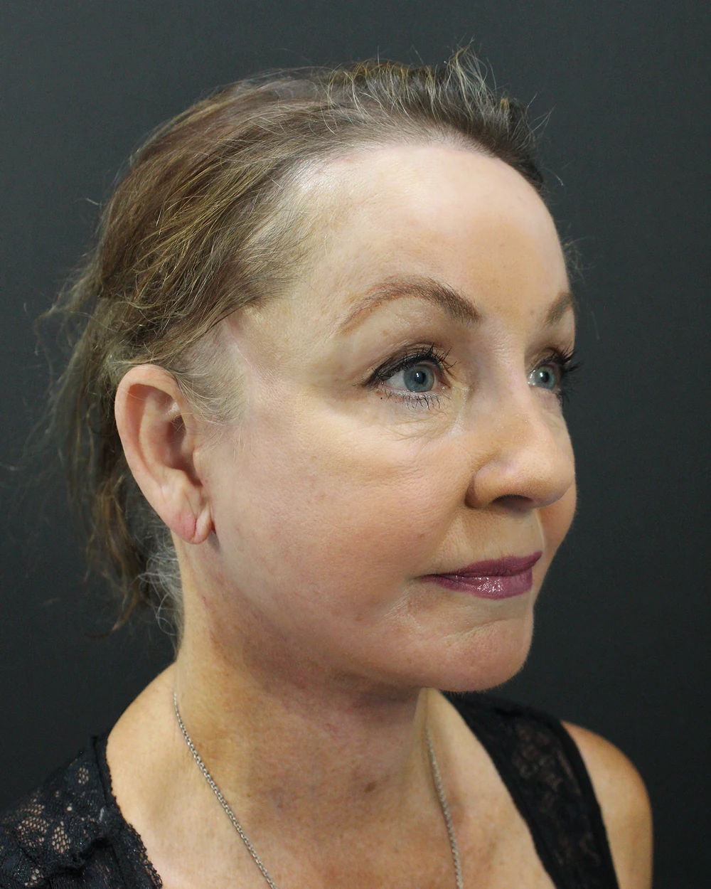 The same jawline and neck after the descended structure was repositioned