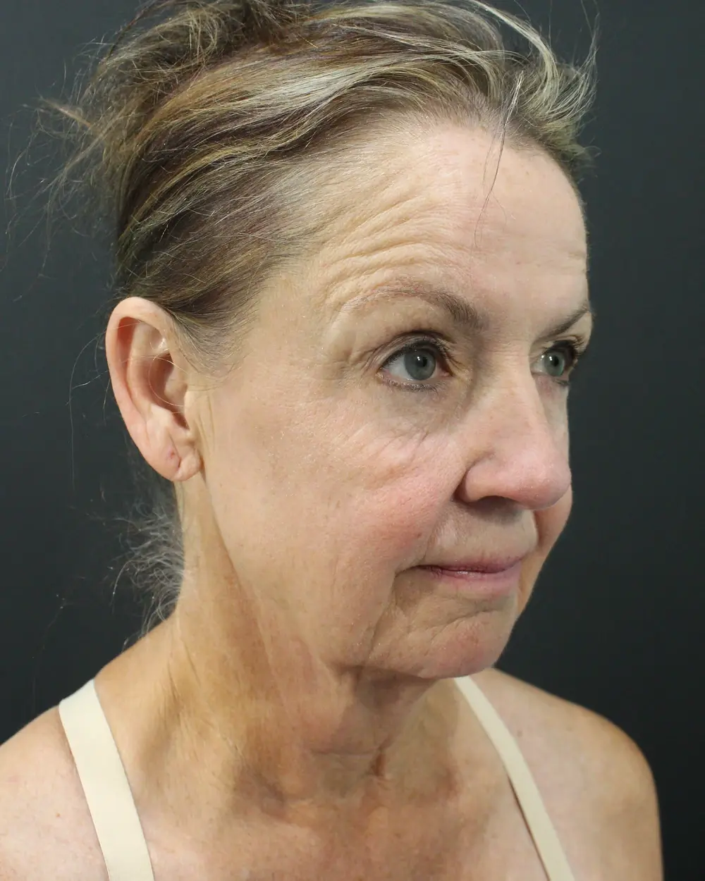 A jawline and neck before surgery