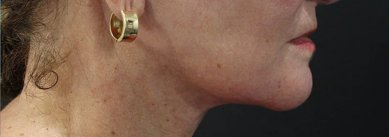 Seven months after a neck lift by Dr. Quiroz: the line of the jaw and the line of the neck meet in a clean corner again. Individual results vary.