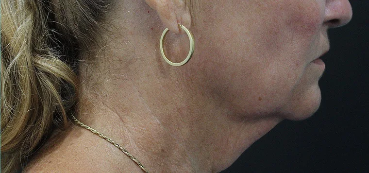 Before a neck lift: the hanging fullness fills the angle under the chin, traced on the photograph.