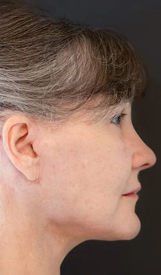 Three months after a face and neck lift by Dr. Quiroz: a clean jawline again. Individual results vary.