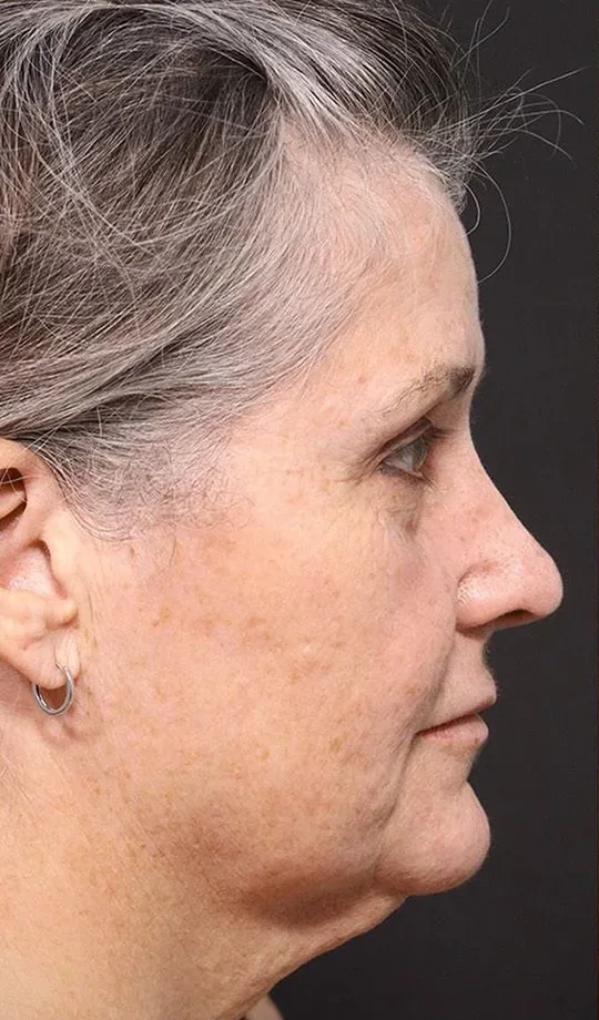 Before a face and neck lift: jowls and a softened jawline, in profile.