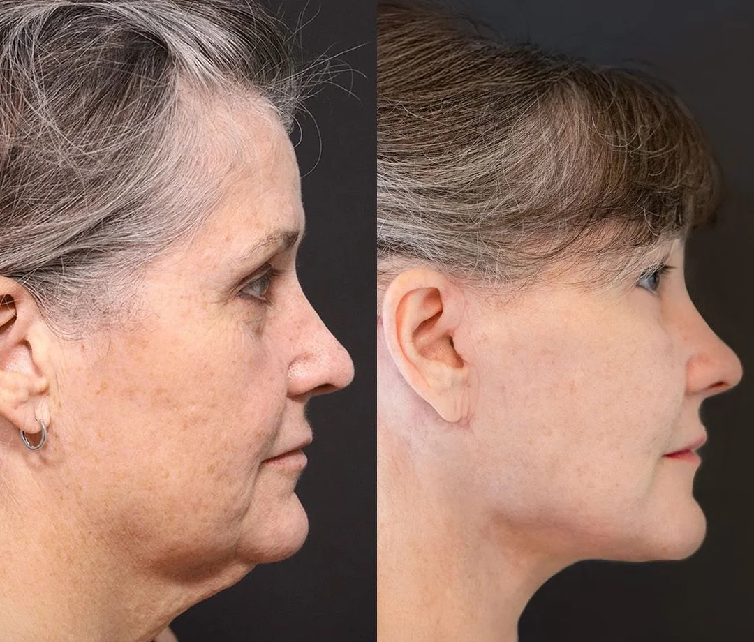 A patient before and after a face and neck lift + lower eyelid surgery by Dr. Quiroz. Individual results vary.