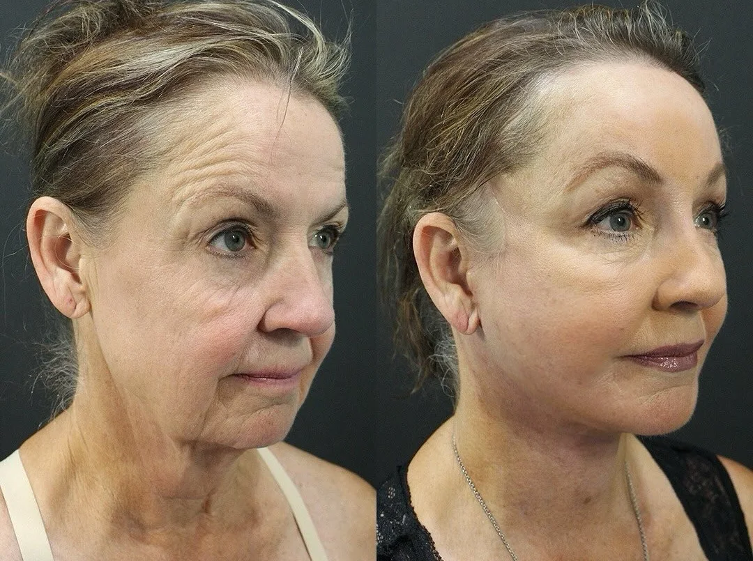A patient before and after a face, neck and brow lift by Dr. Quiroz. Individual results vary.