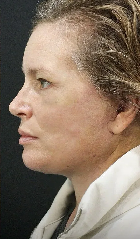 The same neck two weeks after her lift by Dr. Quiroz: the findings corrected. Individual results vary.